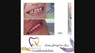 رضایت از کامپوزیت ونیز دندان در کلینیک دندانپزشکی وصال