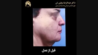 جراحی لیفت میانی صورت با اندوتاین در خانم 60 ساله | فوق تخصص جراحی پلاستیک و زیبایی | دکتر عبدالرضا روئن تن