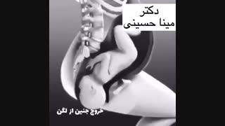 خروج جنین از لگن مادر