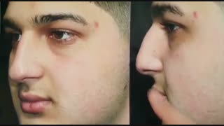 عمل بینی استخوانی | دکتر ابراهیمی جراحی بینی