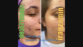 آموزش سابسیژن بهمراه تزریق چربی مجازی حضوری