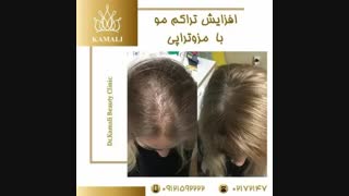 فیلم افزایش تراکم مو با مزوتراپی