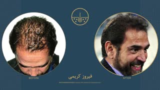فیروز کریمی قبل و بعد از کاشت مو در کلینیک دکتر نیلفروش زاده