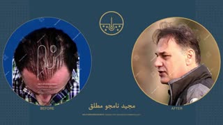 مجید نامجو مطلق قبل و بعد از کاشت مو در کلینیک دکتر نیلفروش زاده