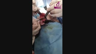 فیلم جراحی لیفت صورت - دکتر محمدرضا ترحمی فوق تخصص جراحی پلاستیک و زیبایی