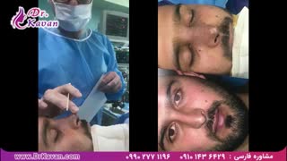 رفع انحراف در بینی مردانه توسط دکتر کاوان