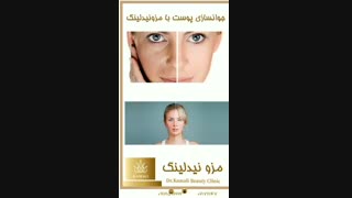 فیلم جوانسازی صورت با مزونیدلینگ