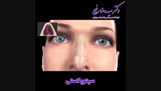 انیمیشن سپتوپلاستی | دکتر رفیع