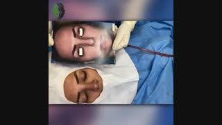 جراحی بینی اولیه با جهت گیری رو به بالای غضروف پره ها | دکتر باستانی نژاد