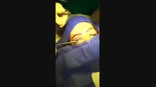 فیلم جراحی بلفارو پلاستی پلک فوقانی پالپوتومی