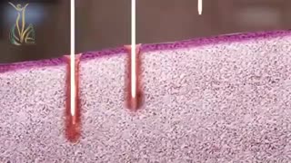 لیزرهای جوانسازی واژن