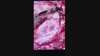 تشنج در دختر ۱۳ ساله باعث تشخیص تومور عمقی در داخل لب تمپورال شد