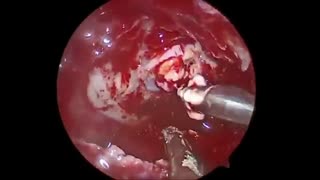 تومور آدنوم هیپوفیز ، آکرومگالی