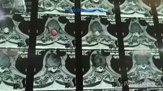 فلجی ناگهانی پا به دنبال تومور نخاع