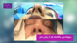 فیلم واقعی بعد از عمل بینی