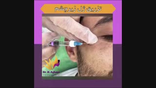 فیلم تزریق ژل زیر چشم