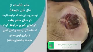 فیلم خانم 80 ساله مبتلا به سرطان سینه