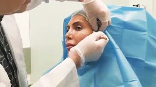 لیفت نخ توسط دکتر نیلفروش زاده ماموپلاستی