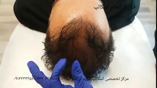 اسکالپ سر آقایان