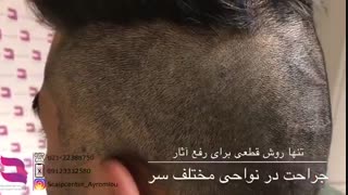 قابل توجه شما که سرتان جای بخیه و جراحت دارد: