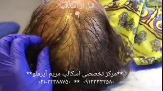 میکرو اسکالپ سر چیست ؟؟؟