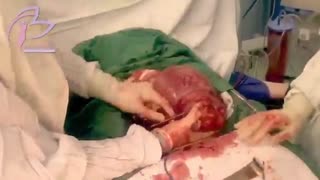 فیلم جراحی برداشتن میوم رحم همراه با سزارین