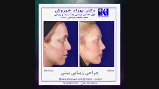 نمونه کار جراحی زیبایی بینی