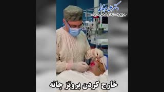 فیلم خارج کردن پروتز چانه
