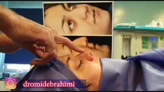 عمل بینی پهن با انحراف | دکتر امید ابراهیمی