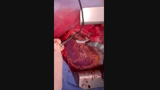 جراحی عروق قلب