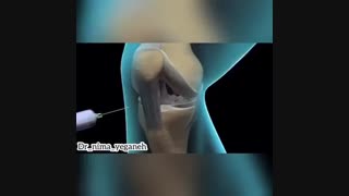 فیلم جذاب تعویض مفصل زانو