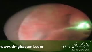 درمان پروستات خوش خیم با لیزر