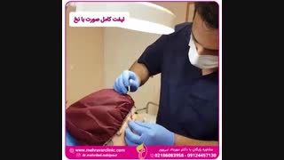 لیفت کامل صورت با نخ