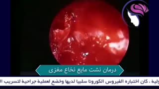 علاج تسرب السلائل الدماغی الشوکی