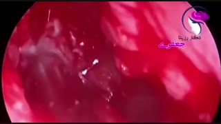 استخدام التنظیر المتقدم