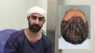 رضایت مراجع کاشت مو در کلینیک دکتر نیلفروش زاده