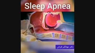 فیلم آپنه انسدادی خواب