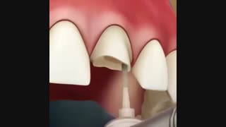 لمینت سرامیکی | کلینیک دندانپزشکی ایده آل