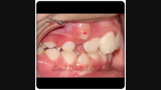ارتودنسی ثابت دو فک | کلینیک دندانپزشکی ایده آل