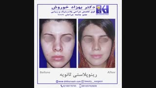 فیلم جراحی بینی مجدد