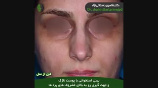 جراحی بینی استخوانی با جهت گیری رو به بالای غضروف پره ها | دکتر باستانی نژاد
