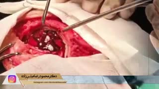 فیلم واقعی خارج ساختن لخته خون از مغز یک خانم 18 ساله