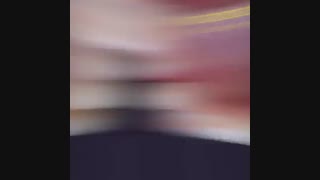 درمان ارتودنسی ثابت دو فک همراه با کشیدن دندان در بیمار با بی نظمی شدید دندانی | دکتر سپیده دادگر