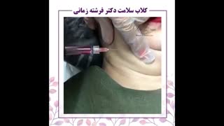مزوتراپی غبغب