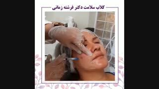 جوانسازی صورت با ژل Ellanse