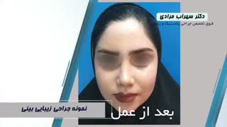 فیلم نمونه عمل زیبایی بینی