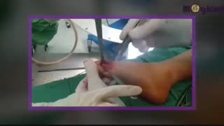 عمل جراحی اصلاح دفرمیتی مادرزادی پا در کودک ۱۰ ساله با استئوتومی