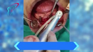 دو عدد ایمپلنت جهت پروز متکی بر اوردنچر