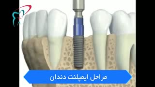 مراحل ایمپلنت دندان