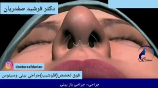 نحوه ی انجام جراحی زیبایی بینی